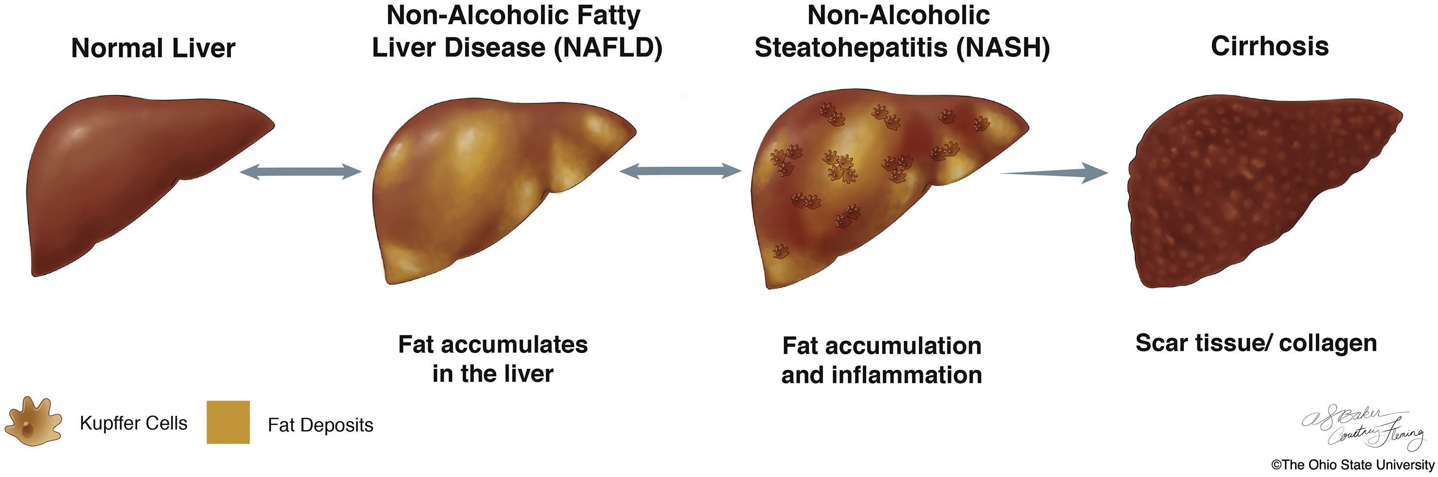 liver_stages.jpg